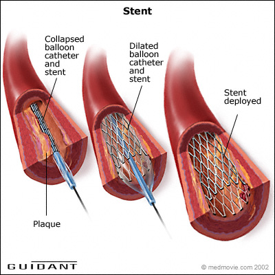 Graphic stent